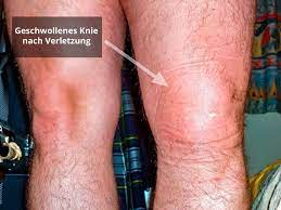 Wasser Im Knie Nach Operation Des Meniskus Behandlung