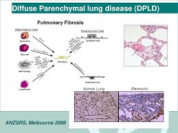 Maybe you would like to learn more about one of these? Pathophysiology Of The Lung Parenchyma Ppt Download
