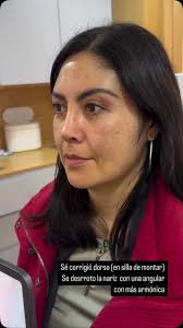 Rinoplastia secundaria de reconstrucción (operado por otro cirujano),con  notables estigmas , •Punta nasal híper rotada (muy levantada), •dorso de la  nariz con silla de montar (tenía un hueco a la ...