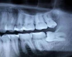 The swelling limits the space for the muscles to move which creates a tension and ultimately limits jaw motion for about 2 weeks. Wisdom Tooth Removal Washington Dc Dc Dental Spa