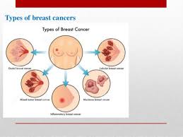 There are many different types of breast cancer. The Breast Cancer And Its Different Type Stages And Grading The T