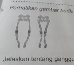 Maybe you would like to learn more about one of these? Jelaskan Tentang Gangguan Tulang Seperti Yang Ditunjukkan Pada Gambar Tolong Dijawab Ya Besok Brainly Co Id