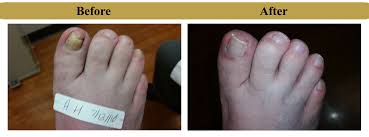 laser treatment for toe nail fungus
