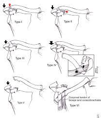 Allman And Rockwood Classification Of Ac Joint Seperation Acromioclavicular Joint Anatomy Joint