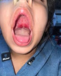 Image result for Tonsillitis