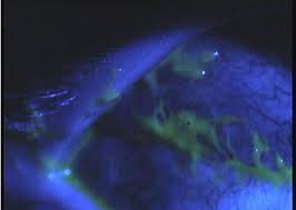 Image result for Seidel Test