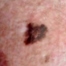 If you've received a diagnosis, here are some things you need to know about the condition. Skin Cancer Types Molechex Skin Cancer And Melanoma Clinic
