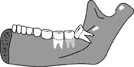 Wisdom teeth usually grow through the gums during the late teens or early twenties. Your Health Care Decisions Getting Wise About Wisdom Teeth