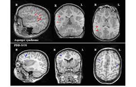What do you know about asperger syndrome? Representation Of Meg Dipoles On Mri Scans In A Case Of Asperger S Download Scientific Diagram