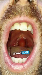 Image result for Uvulitis