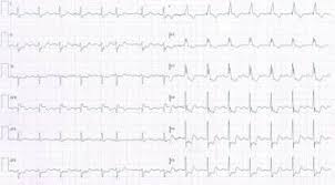 Nstemi is a leading cause of emergency hospitalisation across europe and usa and, for example, accounts for over 50,000 admissions to hospital each year in the national health service of england. Acute Myocardial Infarction Mi Cardiovascular Disorders Msd Manual Professional Edition