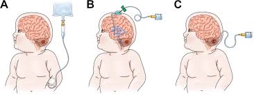 How to tell if someone needs cpr. Frontiers Car T Cell Therapy For Pediatric Brain Tumors Oncology