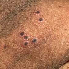 Image result for genital herpes