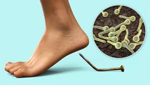 Image result for Tetanus