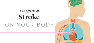 Recovery from stroke and addressing complications as a result of a stroke event will be a different process for each survivor. The Effects Of Stroke On The Body