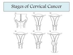 Menurut jane, pencegahan kanker serviks juga dapat dilakukan dengan. Cegah Kanker Serviks Dengan Vaksin Hpv Prosehat