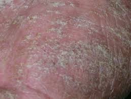 A study conducted in india evaluated 814 patients with scabies who used a paste made from neem oil and turmeric for treatment. Scabies Dermnet Nz