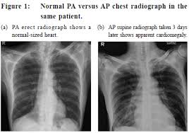 Image result for Chest XRay Interpretation