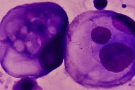 The five year survival rate for pancreatic cancer. Cruk Tests Drug Combo For Advanced Pancreatic Cancer
