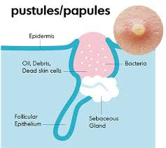 Image result for Pustule