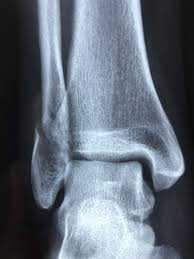 Image result for Fracture XRay