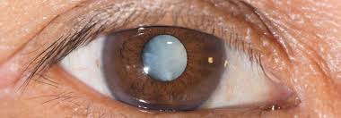 Hier meine frage die op ist jetzt zwei tage her. Grauer Star Operation Medical Eye Care