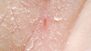 Image result for itchy skin rectum