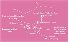 Sometimes people with metastatic breast cancer do not have any of these changes. National Campaign For Breast Cancer Awareness Causes And Symptoms Of Breast Cancer