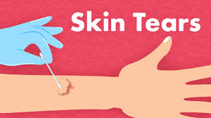 Image result for Skin Tear