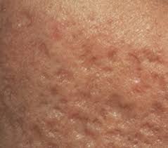 Acne scars before and after home remedies. Acne Scar Treatment Home Remedy For Acne Scars Infofru