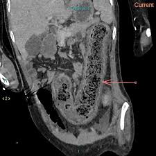 Image result for Neutropenic Colitis