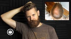 The buzz cut is always a classic choice for men with hair loss, and it can look really good on a lot of guys. How To Handle Men S Thinning Hair Here Is What You Can Do About It Beardbrand