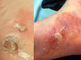 Image result for penis mycosis symptoms
