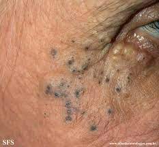 Is a form of sun damage. Favre Racouchot Syndrome Is A Solar Dermatology Clinic Facebook
