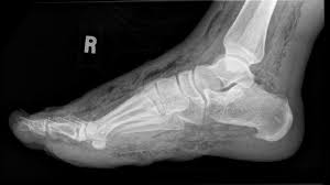 Program within @mayoclinicgradschool is currently accepting applications! Necrotizing Fasciitis X Ray Wikidoc