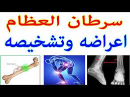 سرطان العظام اعراضه وتشخيصه youtube