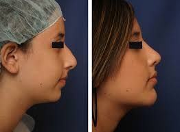 Nose Chin Cheek And Facial Reshape Augmentation