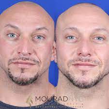 Maybe you would like to learn more about one of these? Male Deviated Septum Rhinoplasty Before And After Head And Neck Surgeon
