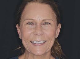 Replacing 30-Year-Old Veneers to Improve Smile Esthetics