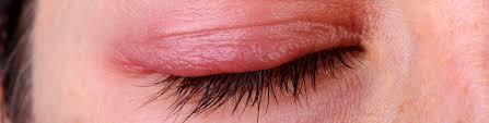 Blepharitis, in turn, may cause styes, pinkeye, and chalazions. Blepharitis Moses Eyecare Centers