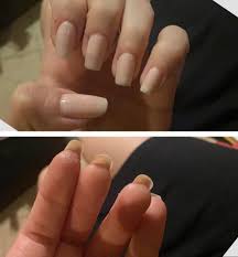 Looks way worse than when you just bite the skin around your nails. 2 Months Of No Nail Biting Still Can T Stop Biting My Skin Calmhands