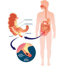 Appendix cancer is very rare, and many people experience no symptoms in the early stages. Appendix Surgery