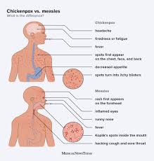 Image result for measles