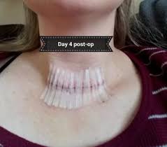 Life After Thyroidectomy Parathyroidectomy Photos Thyroidectomy Thyroid Surgery Thyroid Surgery Recovery