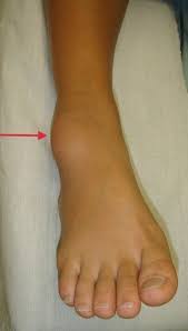 Hallux Valgus Dr Michael Vitek 1120 Wien