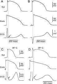 Osborn wave, camel hump sign of osborn, hypothermic hump, late delta wave, hathook junction, j wave, h wave, k wave. J Wave Syndromes Heart Rhythm