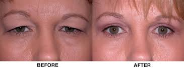 Eyelid Surgery Premier Ent Cosmetics Eyelid Surgery Eye Surgery Hooded Eye Surgery