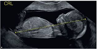 Image result for First Trimester Ultrasound
