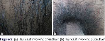 Heredity may make a person predisposed to premature graying, including hair in the pubic region. Figure 2 From Adult Onset Hair Casts Nits Which Do Not Itch Semantic Scholar