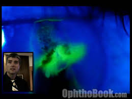 Image result for Seidel Test